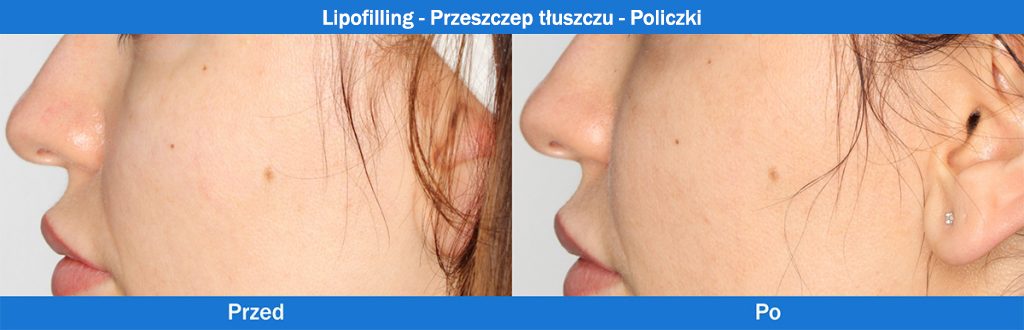Lipofilling - Przeszczep tłuszczu - Policzki